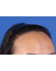 After Hair Transplant&nbsp;Hairline